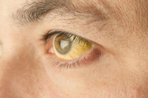 Пожелтела кожа и глаза. Белки желтого цвета означают болезнь? Причины пожелтения глаз